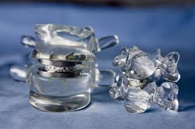 Spinal Kinetics M6 Disc Replacement