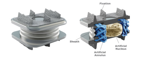Spinal Kinitics M6 Artificial Disc Replacement study outcomes Cervical Disc Replacement