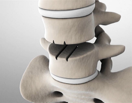 disc-replacement-channels
