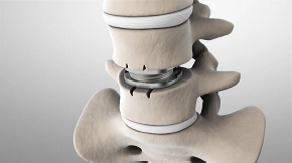 disc-replacement-in-place