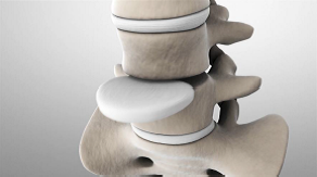 disc-replacement-removal-of-disc