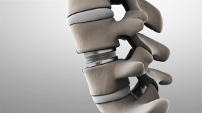 disc-replacement-side-view