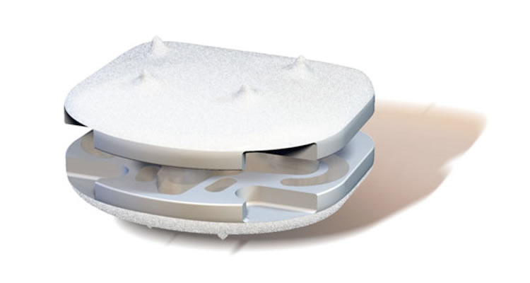 Cervical ESP Disc Replacement